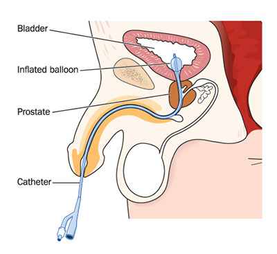 Urinary Leakage Incontinence Rose City Urology in Tyler Texas